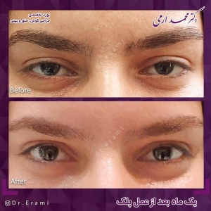 جراحی-پلک-17