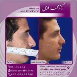 جراحی-بینی-در-کاشان-150