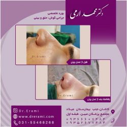 جراحی-بینی-در-کاشان-151