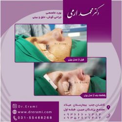 جراحی-بینی-در-کاشان-152