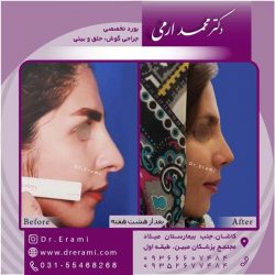جراحی-بینی-در-کاشان-153