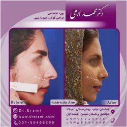 جراحی-بینی-در-کاشان-154