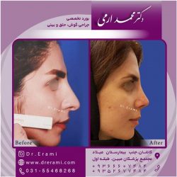 جراحی-بینی-در-کاشان-155