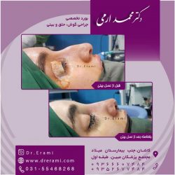 جراحی-بینی-در-کاشان-156
