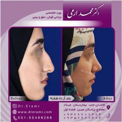 جراحی-بینی-در-کاشان-157