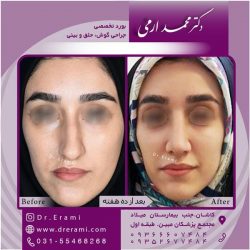 جراحی-بینی-در-کاشان-158