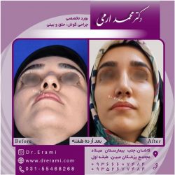 جراحی-بینی-در-کاشان-159