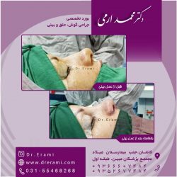 جراحی-بینی-در-کاشان-160