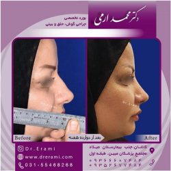 جراحی-بینی-در-کاشان-161