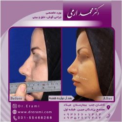 جراحی-بینی-در-کاشان-162