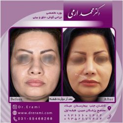جراحی-بینی-در-کاشان-163
