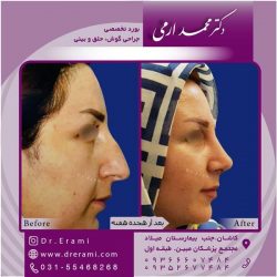 جراحی-بینی-در-کاشان-164