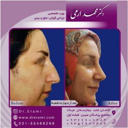 جراحی-بینی-در-کاشان-165