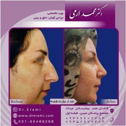 جراحی-بینی-در-کاشان-166