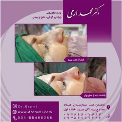 جراحی-بینی-در-کاشان-167