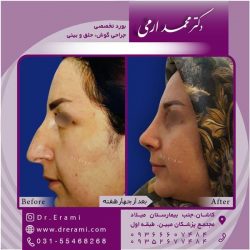 جراحی-بینی-در-کاشان-168