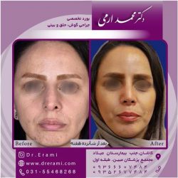 جراحی-بینی-در-کاشان-169