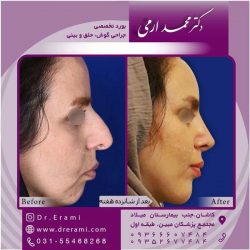 جراحی-بینی-در-کاشان-170