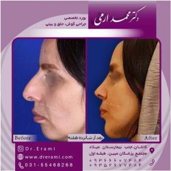 جراحی-بینی-در-کاشان-171
