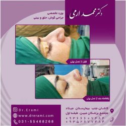 جراحی-بینی-در-کاشان-172