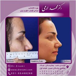 جراحی-بینی-در-کاشان-173