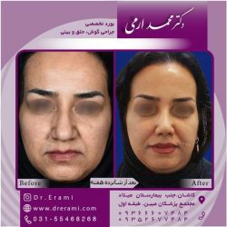 جراحی-بینی-در-کاشان-175