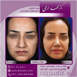 جراحی-بینی-در-کاشان-176