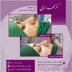 جراحی-بینی-در-کاشان-177