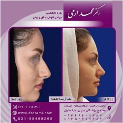 جراحی-بینی-در-کاشان-178