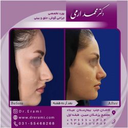 جراحی-بینی-در-کاشان-179