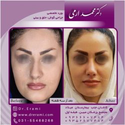 جراحی-بینی-در-کاشان-180