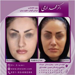 جراحی-بینی-در-کاشان-181
