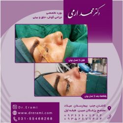 جراحی-بینی-در-کاشان-182