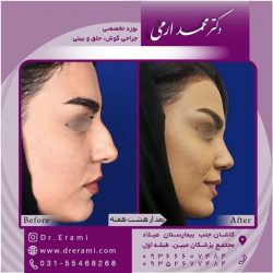 جراحی-بینی-در-کاشان-183