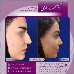 جراحی-بینی-در-کاشان-184