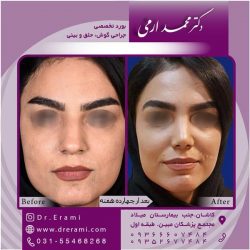 جراحی-بینی-در-کاشان-185
