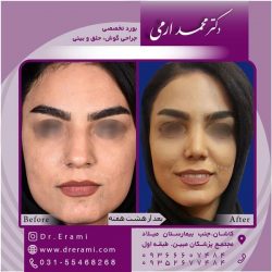 جراحی-بینی-در-کاشان-186