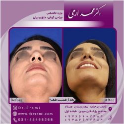جراحی-بینی-در-کاشان-187