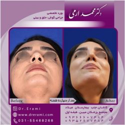 جراحی-بینی-در-کاشان-188