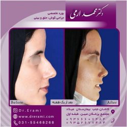 جراحی-بینی-در-کاشان-190