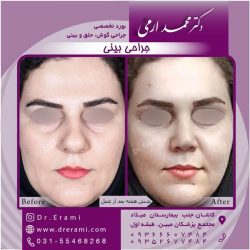 جراحی-بینی-در-کاشان-198