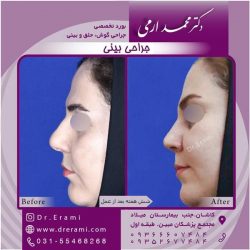 جراحی-بینی-در-کاشان-199