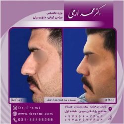 جراحی-بینی-کاشان-100