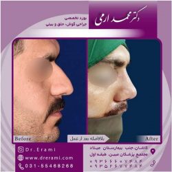 جراحی-بینی-کاشان-101