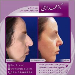 جراحی-بینی-کاشان-102