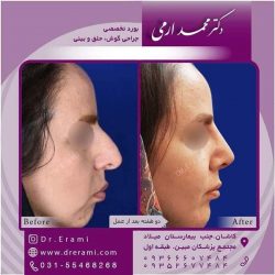 جراحی-بینی-کاشان-103