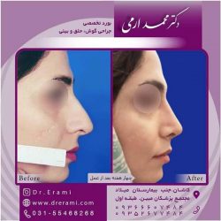 جراحی-بینی-کاشان-105