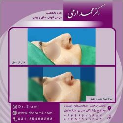 جراحی-بینی-کاشان-106