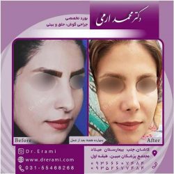 جراحی-بینی-کاشان-107