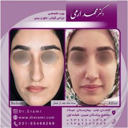 جراحی-بینی-کاشان-110